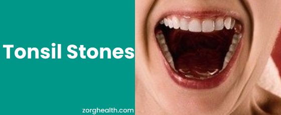 tonsil stones
