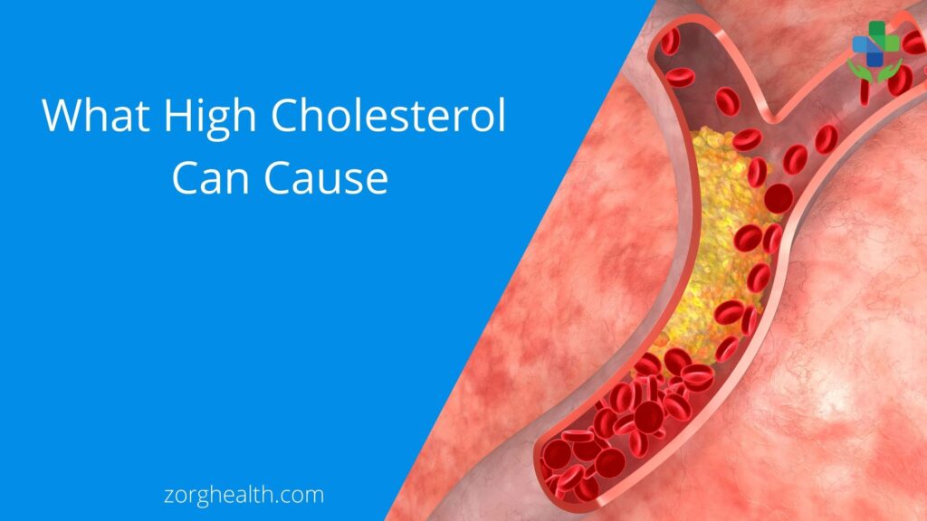 What High Cholesterol Can Cause