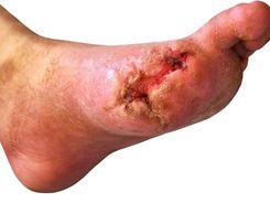 What is Diabetic Foot Ulcer Causes & Treatment